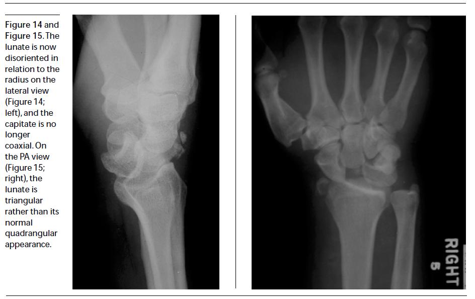 Lunate Dislocations